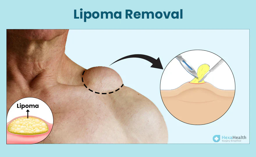 How Lipoma gets treated?