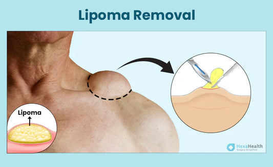 How Lipoma gets treated?