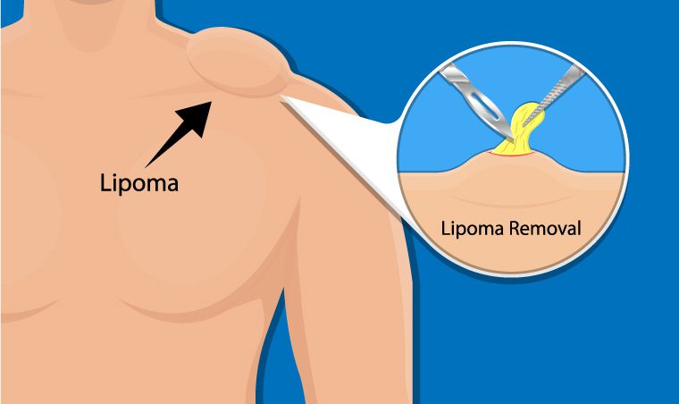 How to Keep Lipomas at Bay: A Step by Step Guide