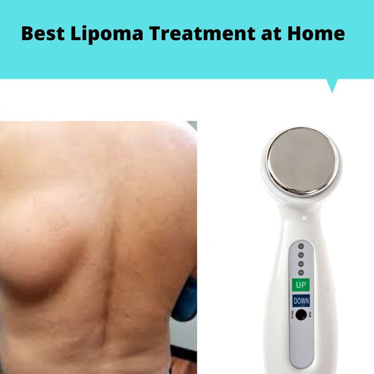 Get Lipoma Treatment At Home with Lipoma Wand