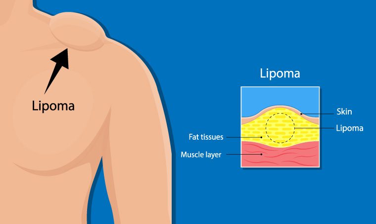 How do you stop Lipoma’s from growing?