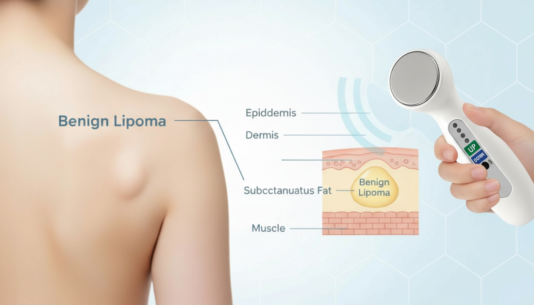 Benign fatty lipomas: understanding overgrown fat cells