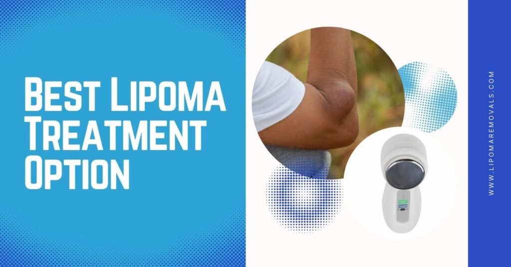 Best Lipoma Treatment Option