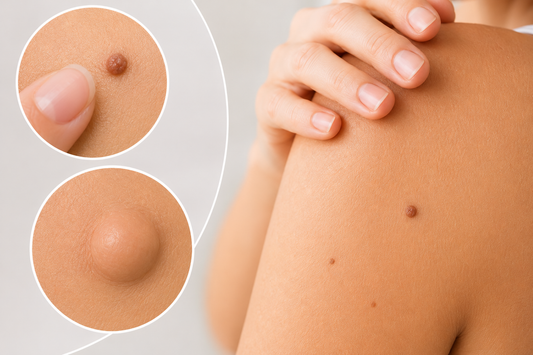 Effective and Pain-Free At-Home Mole and Lipoma Removal Methods in 2026