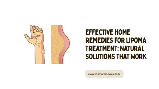 Effective Home Remedies for Lipoma Treatment: Natural Solutions That Work