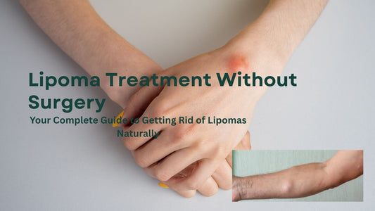 Your Complete Guide to Getting Rid of Lipomas Naturally