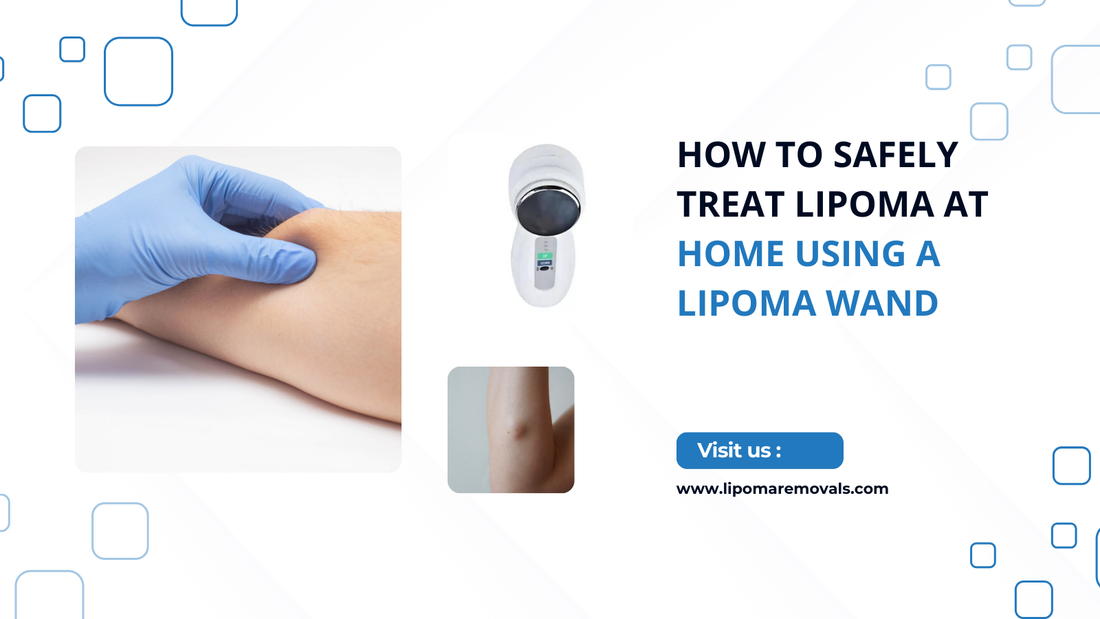 How to Safely Treat Lipoma at Home Using a Lipoma Wand