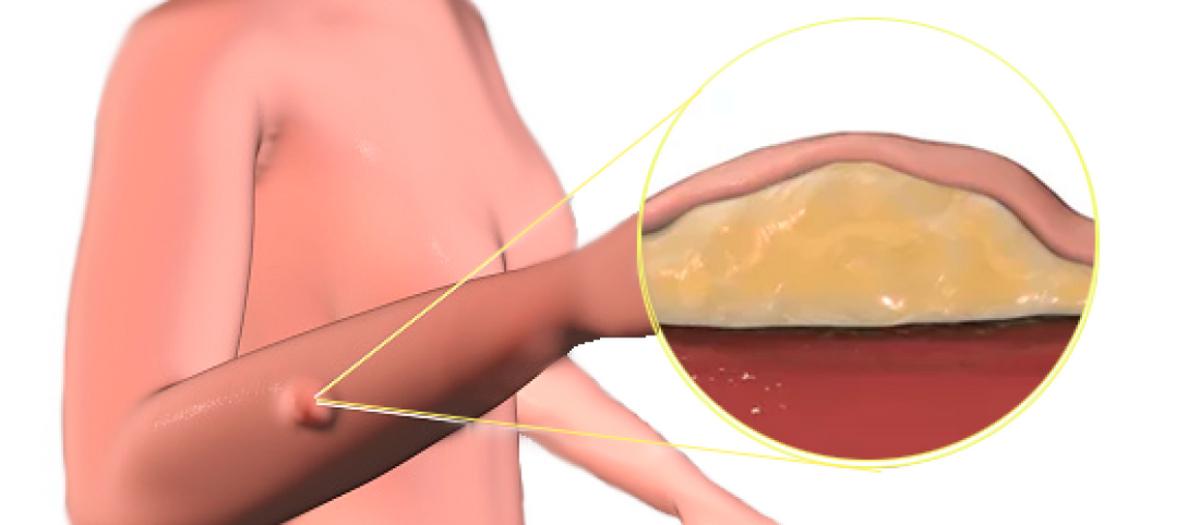 Are There Risks in Lipoma Treatment?