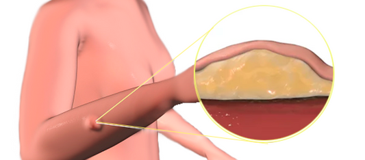 Are There Risks in Lipoma Treatment?