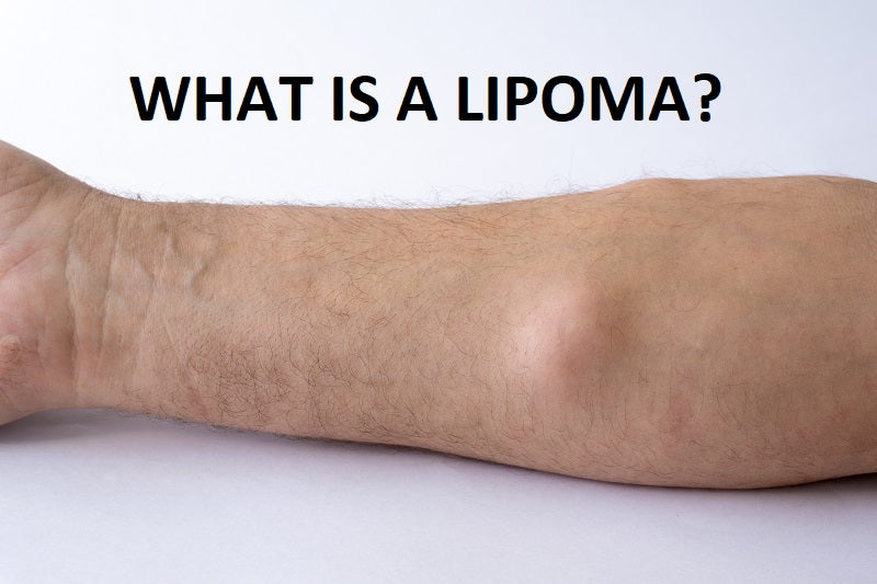 The Ultimate Guide for Lipoma and Its Natural Treatment