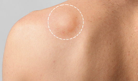 Know the Causes of Lipoma & Stop Its Occurrence at Home