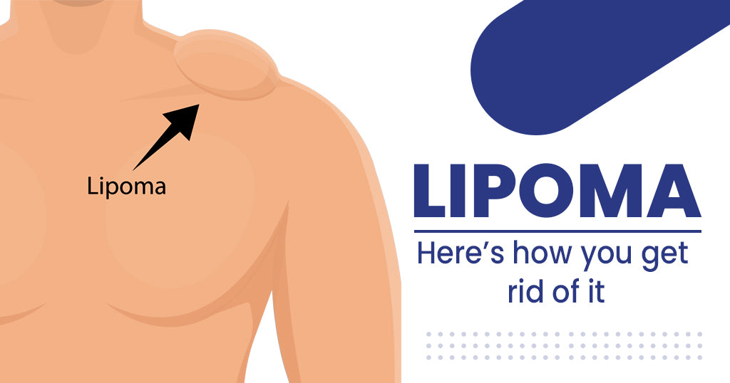 Get Rid of Fatty Lumps with Lipoma Removal at Home