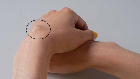 Get To Know What Causes Lipoma To Hurt?