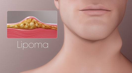 What Do I Do if I Have a Lipoma?