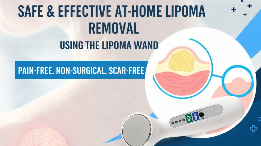 Explore A Smarter Way to Treat Lipomas at Home: Lipoma Wand