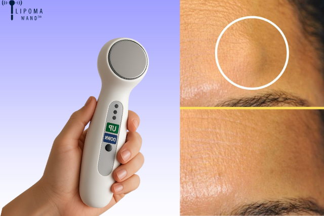 Lipoma Wand Treatment: How to Remove a Lipoma Yourself Safely at Home?