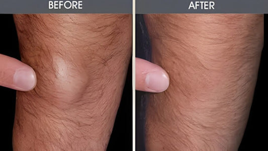 Painless Lipoma Removal: Experience the Difference