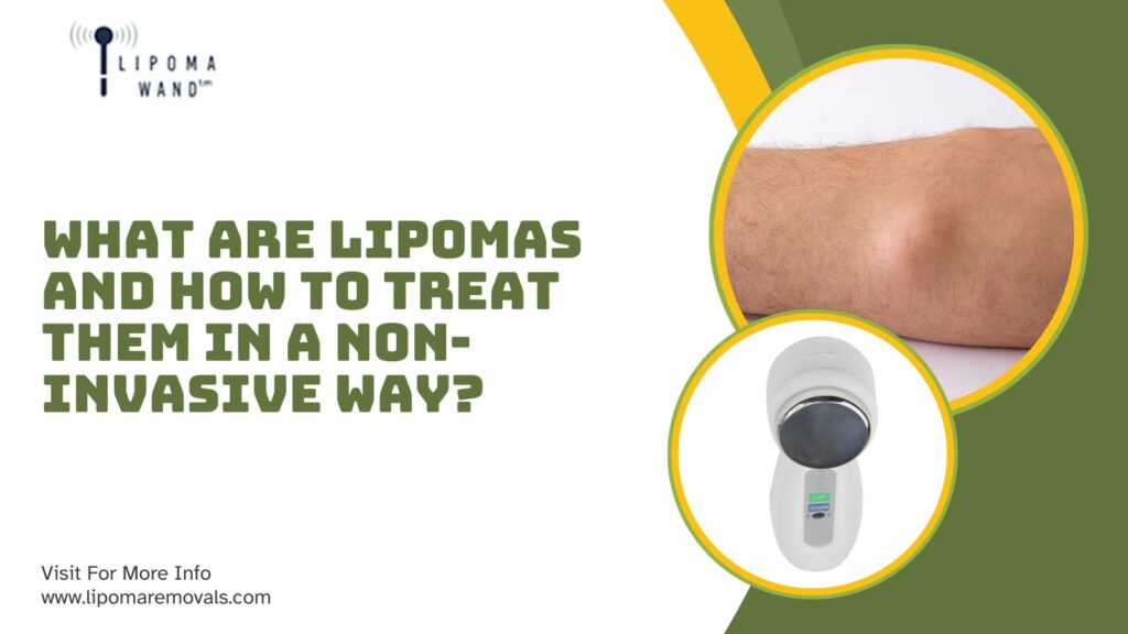 What are lipomas and How to treat them in a non-invasive way?