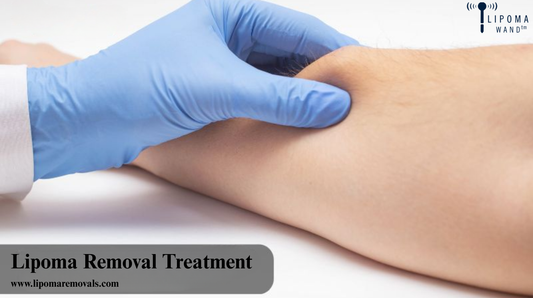What is the Easiest Way to Remove a Lipoma?