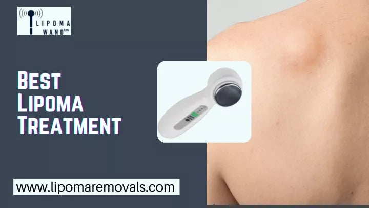 Painfree Lipoma Removal Without Surgery Is Possible With Lipoma Wand