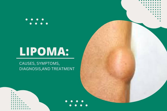 Know About Lipoma – Causes, Symptoms & Natural Treatment