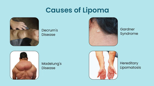 What are Lipomas and why do they Form