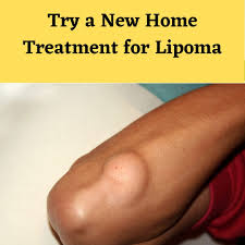 Try a New Home Treatment for Lipoma – Lipoma Wand