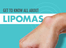 What are Causes of Fatty Tissues under Skin? | Lipoma Treatment