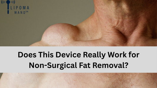 Lipoma Wand Review: Does This Device Really Work for Non-Surgical Fat Removal?