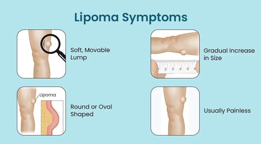 How To Detect Lipoma And Get a Safe Lipoma Treatment?