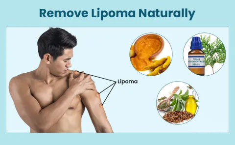 How can I get rid of lipomas naturally?