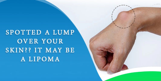 Lipoma Removal- What You Need to Know About Fatty Lumps