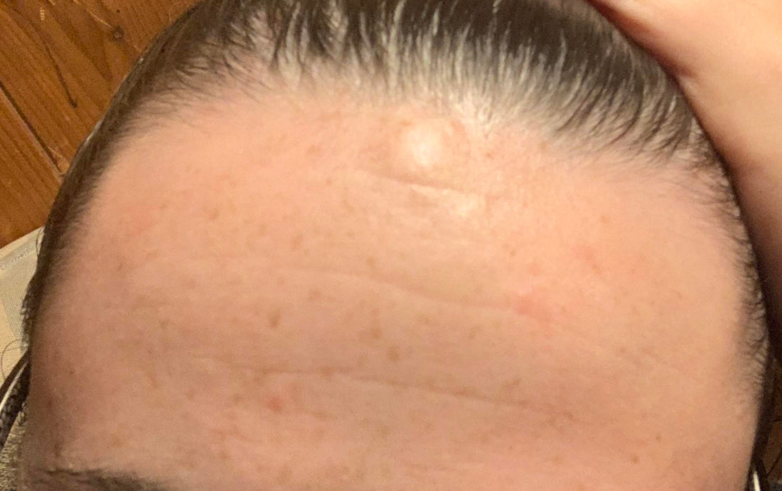 Know About Forehead Lipoma Removal Without Surgery