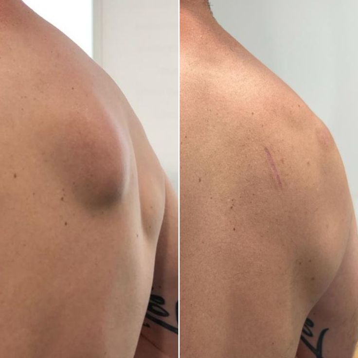 Before and after comparison of a shoulder with a large mole on the left and a smaller, more defined mole on the right.