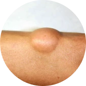 Lumps range in size,
usually between 2 to 10 cm